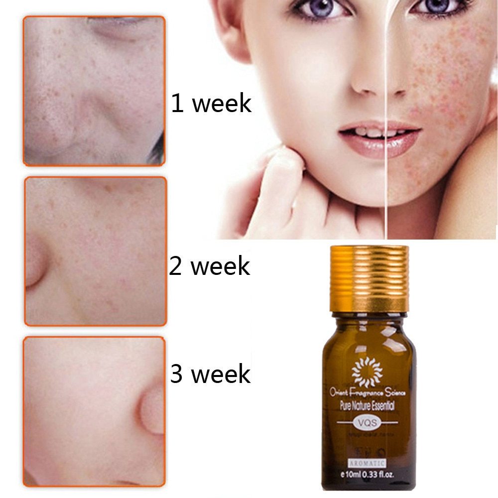 Acne Scar Treatment Oil | Natural Blend to Fade Blemishes & Improve Sk ...